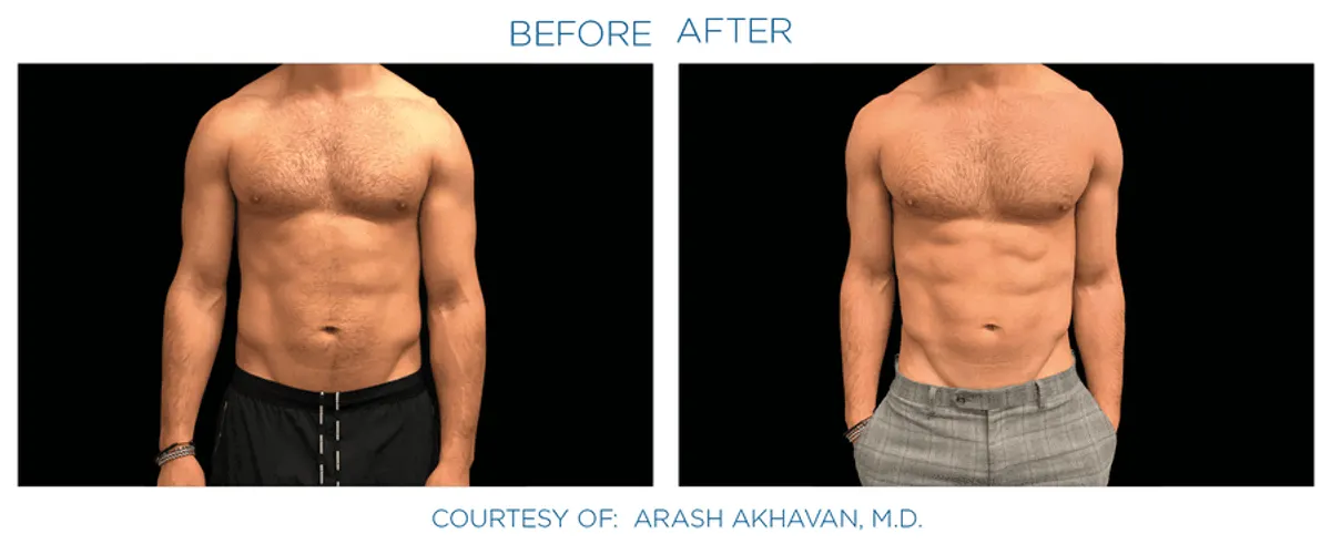 Emsculpt Neo effect on abdomen