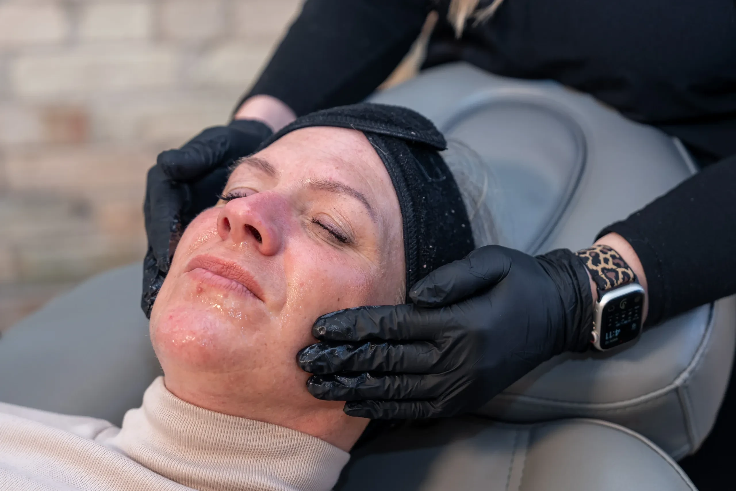 Laser Skin Resurfacing with Helix CO2