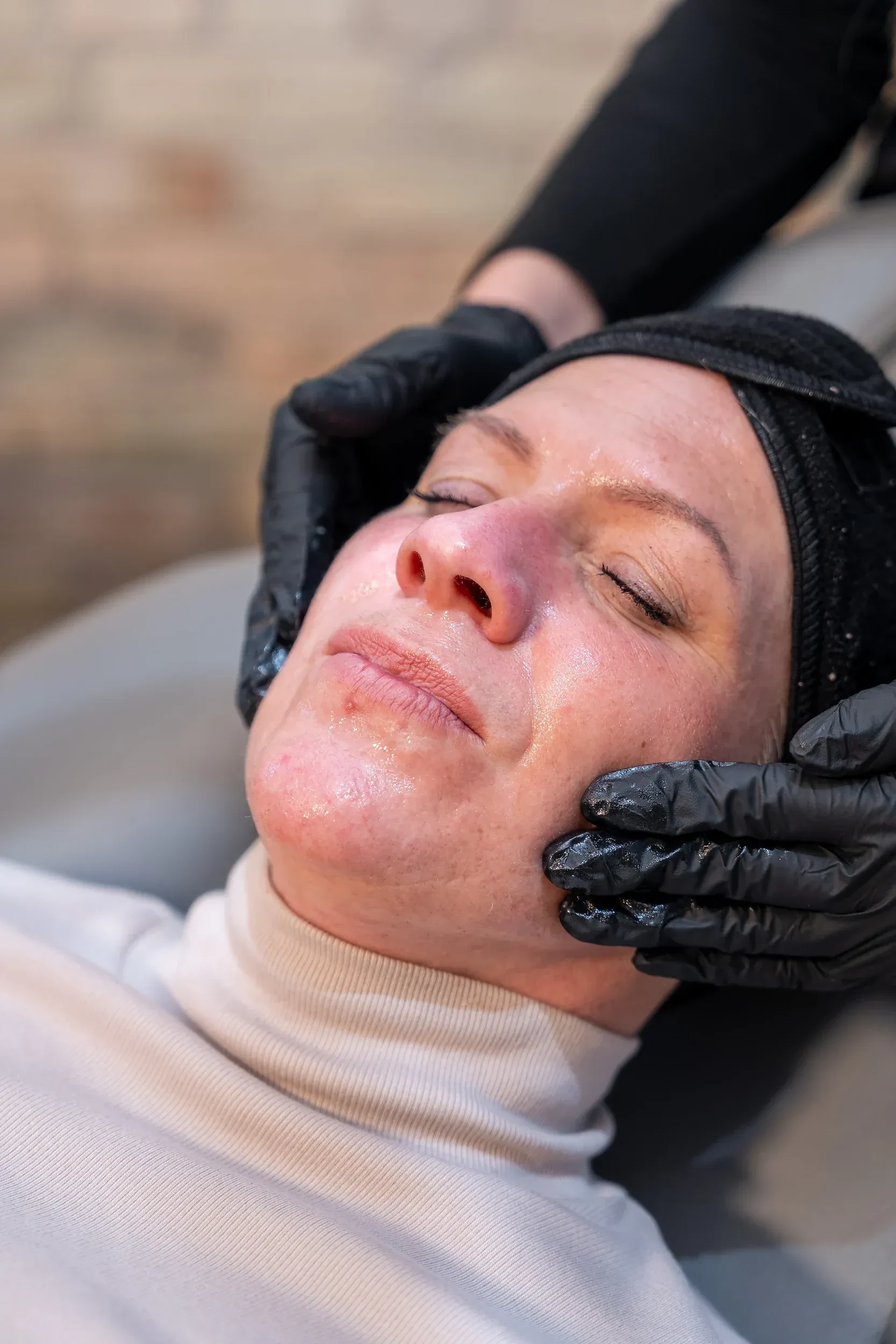 Before and after Helix CO2 laser results showing skin rejuvenation at Eternal Wellness Traverse City