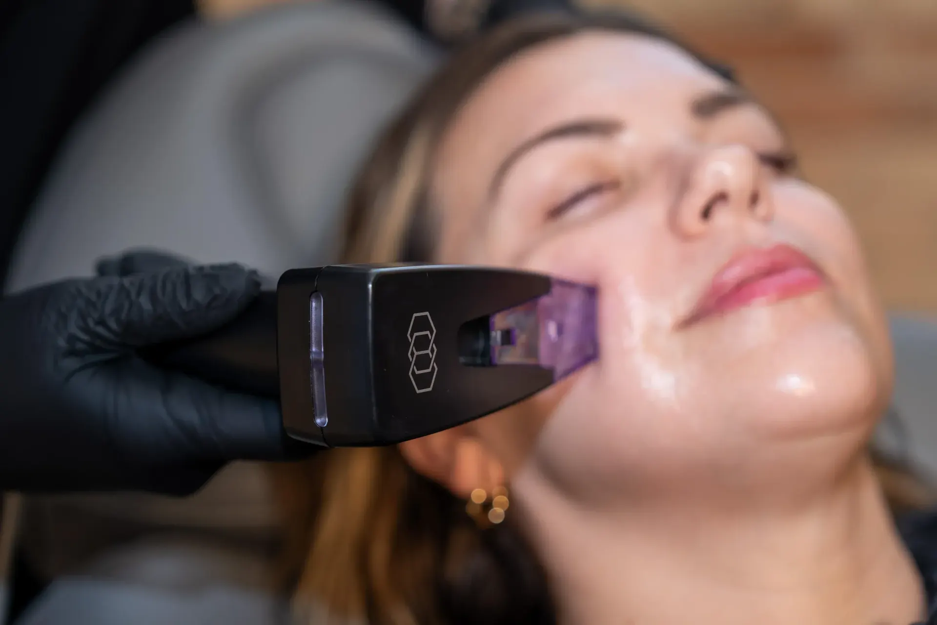 Morpheus8 RF microneedling treatment at Eternal Wellness Medical Spa in Traverse City MI