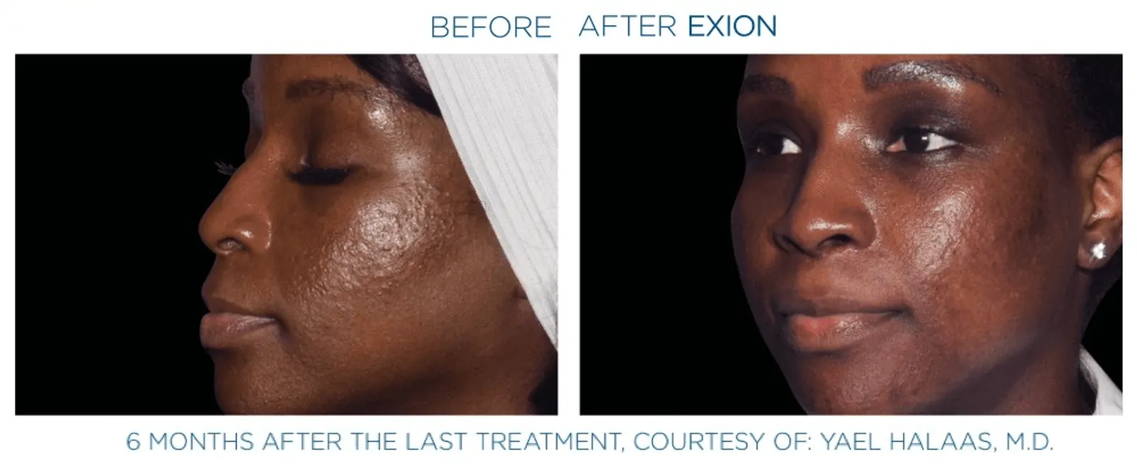 Exion effect on the face