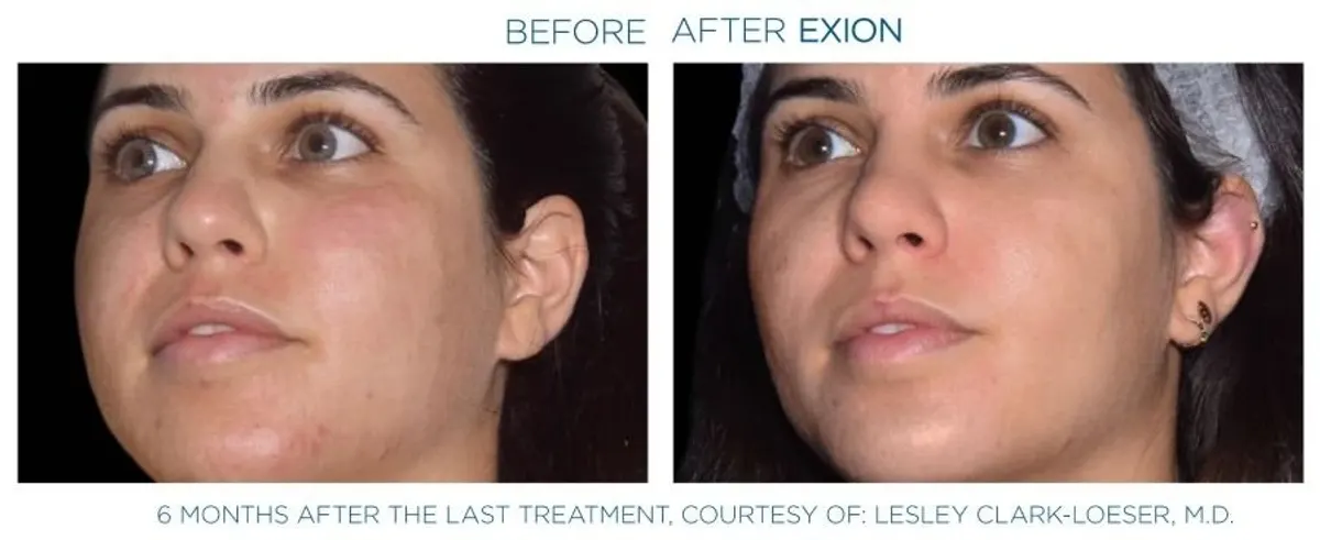 Exion effect on the face