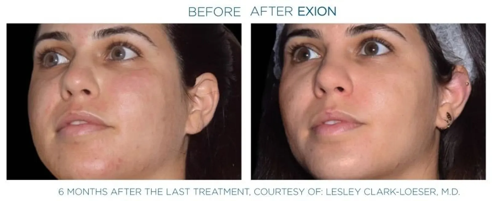 Exion effect on the face
