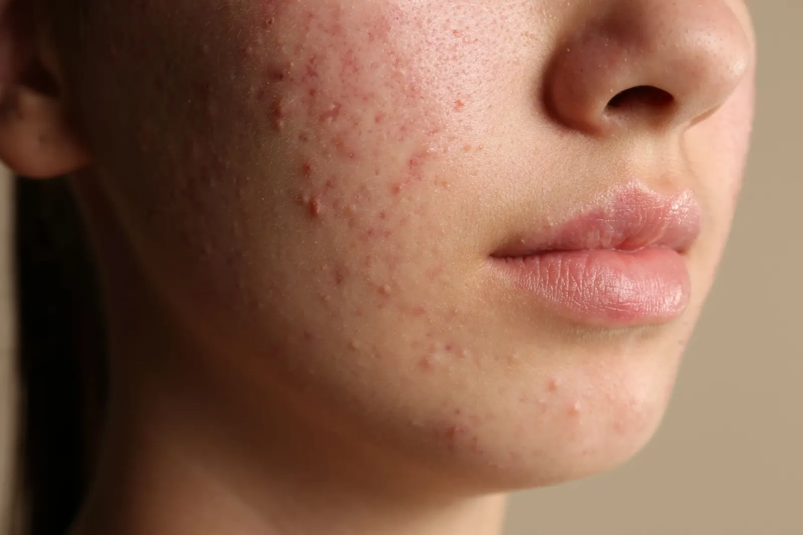 Illustration of acne formation and scarring process at Eternal Wellness Medical Spa