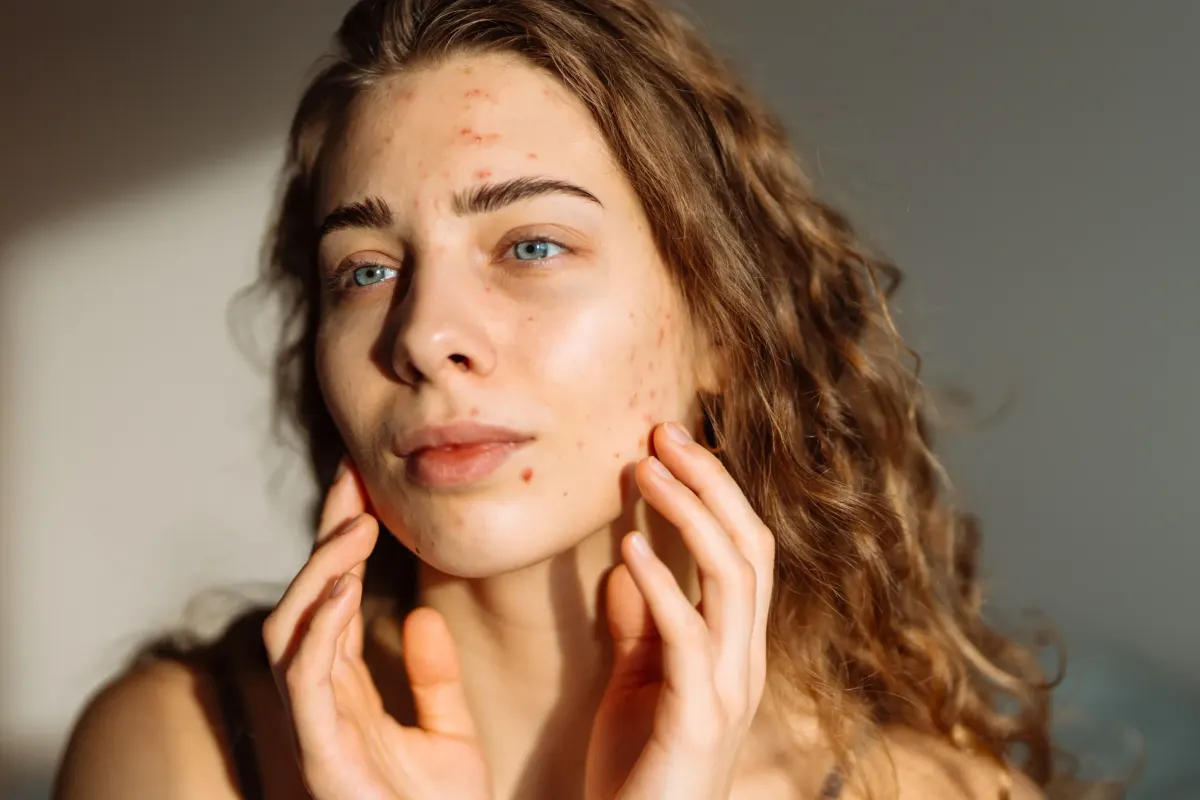 Woman with clear skin after acne treatment at Eternal Wellness Medical Spa Traverse City