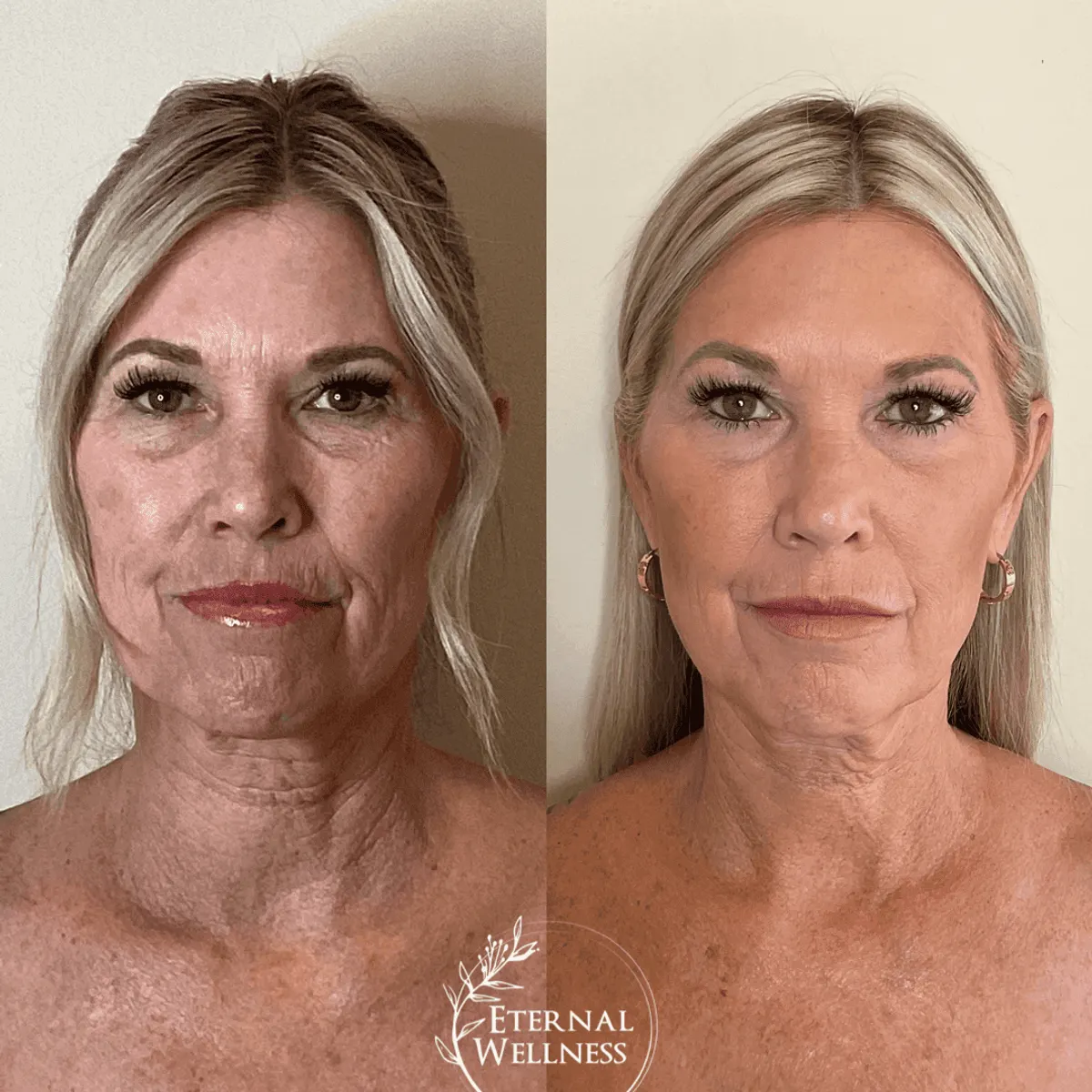 Morpheus8 Face before and after