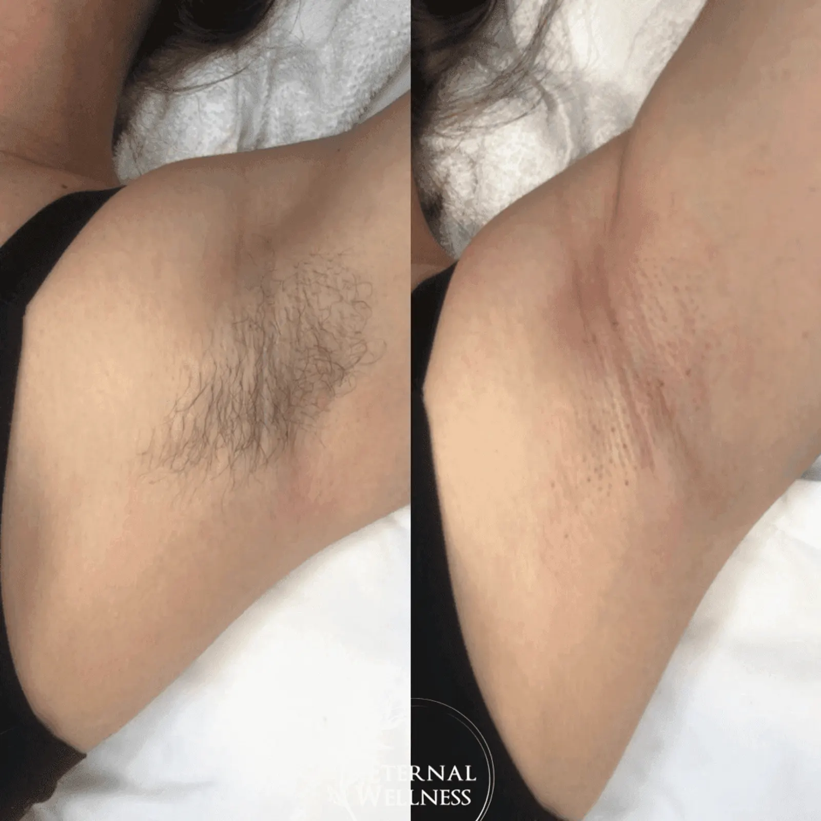 DiolazeXL Laser Hair Removal - Before and After