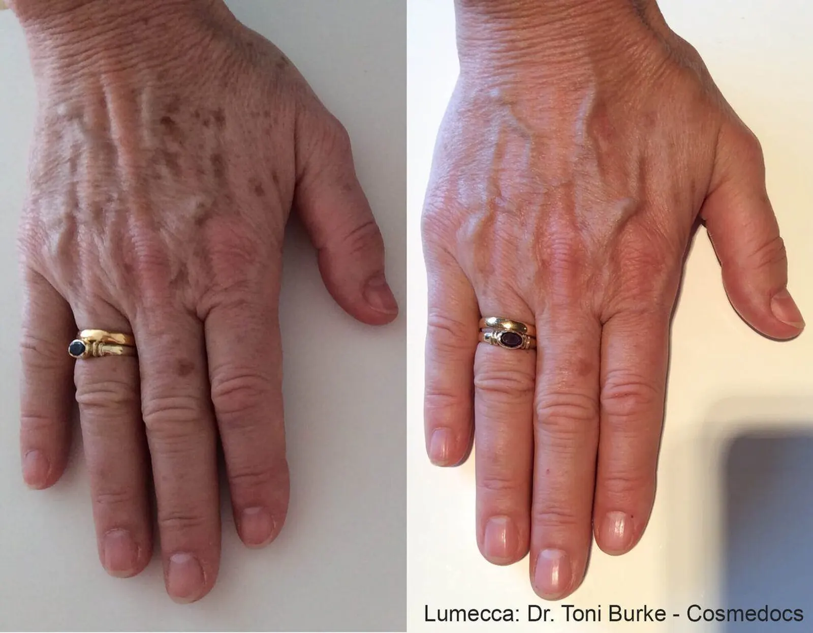 Lumecca IPL Body - Before and After