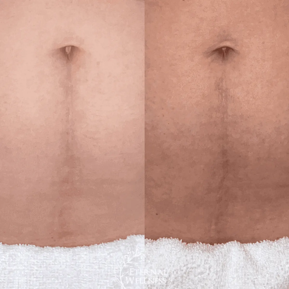 Morpheus8 Body before and after