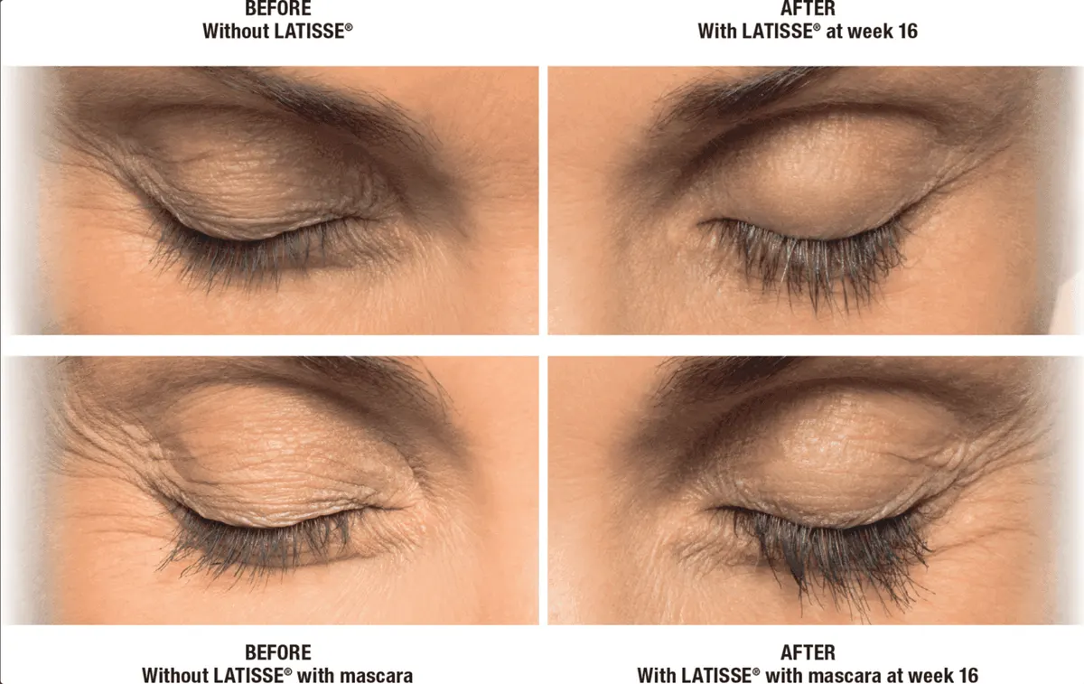 Latisse before and after