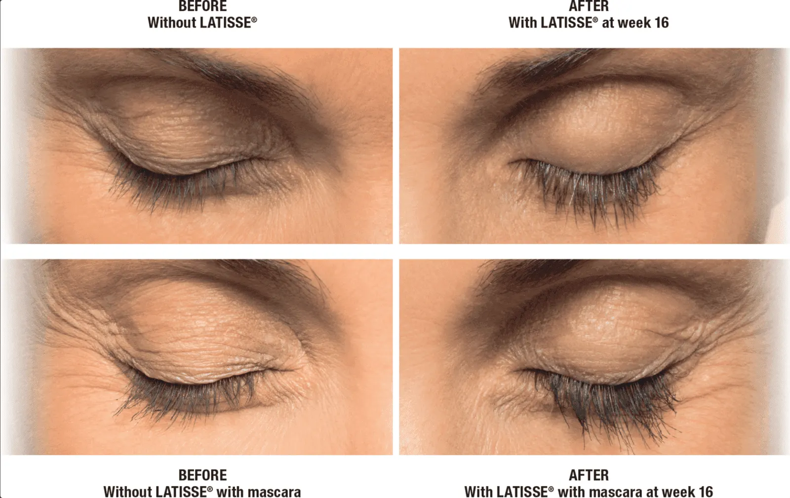 Latisse - Before and After