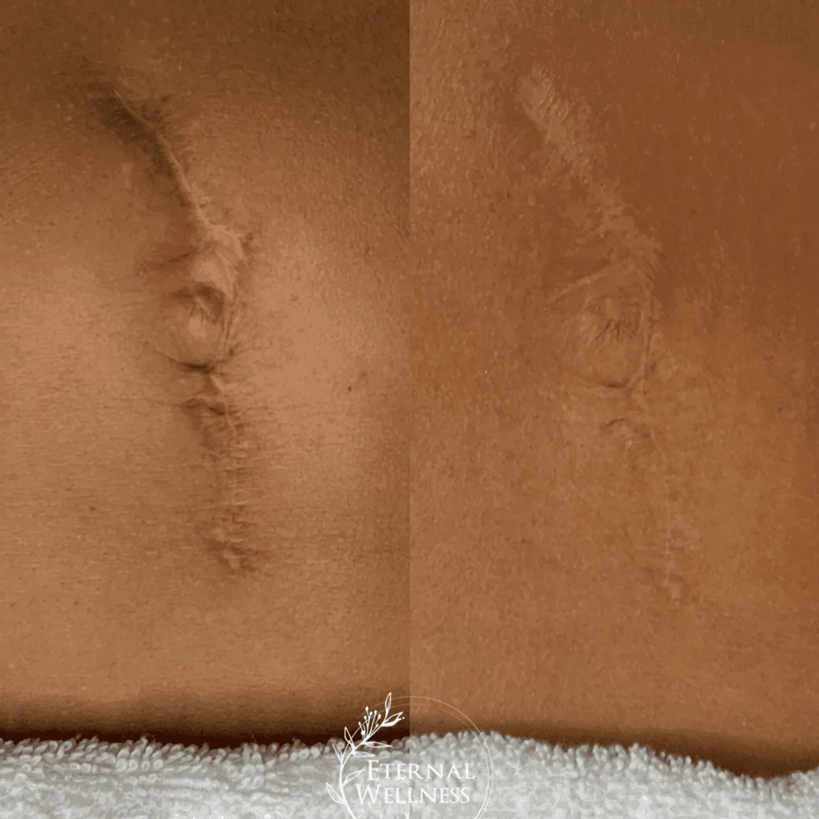 Morpheus8 Body - Before and After