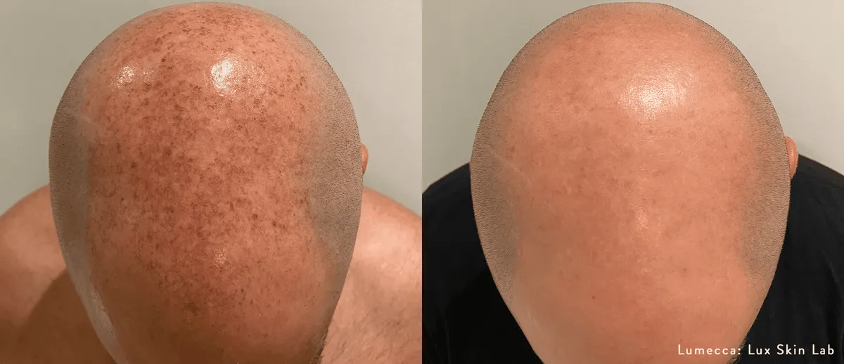 Lumecca IPL Body before and after
