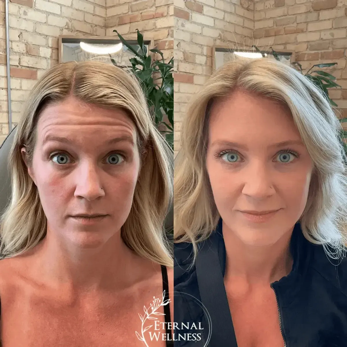 Dysport before and after