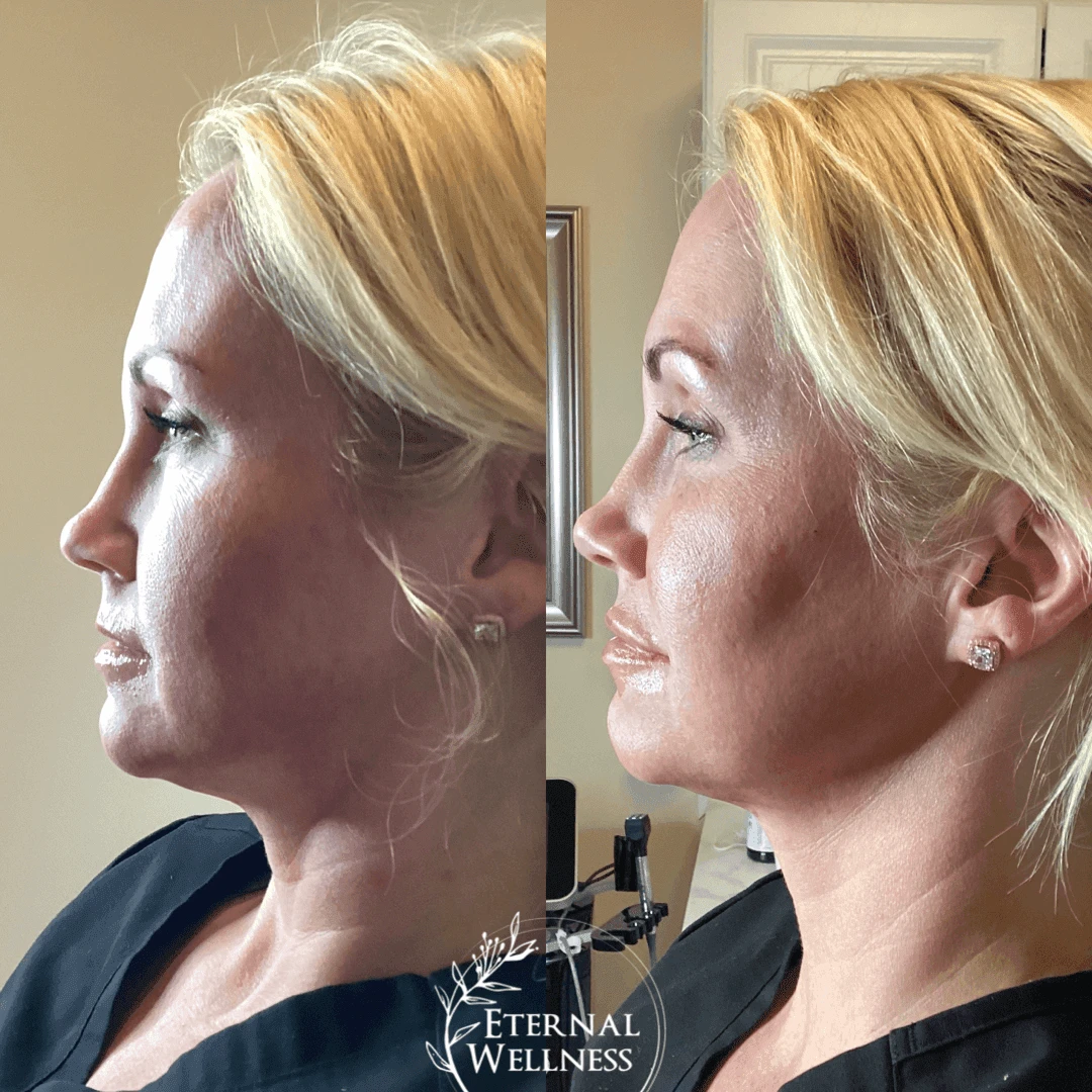 Dermal Fillers - Before and After