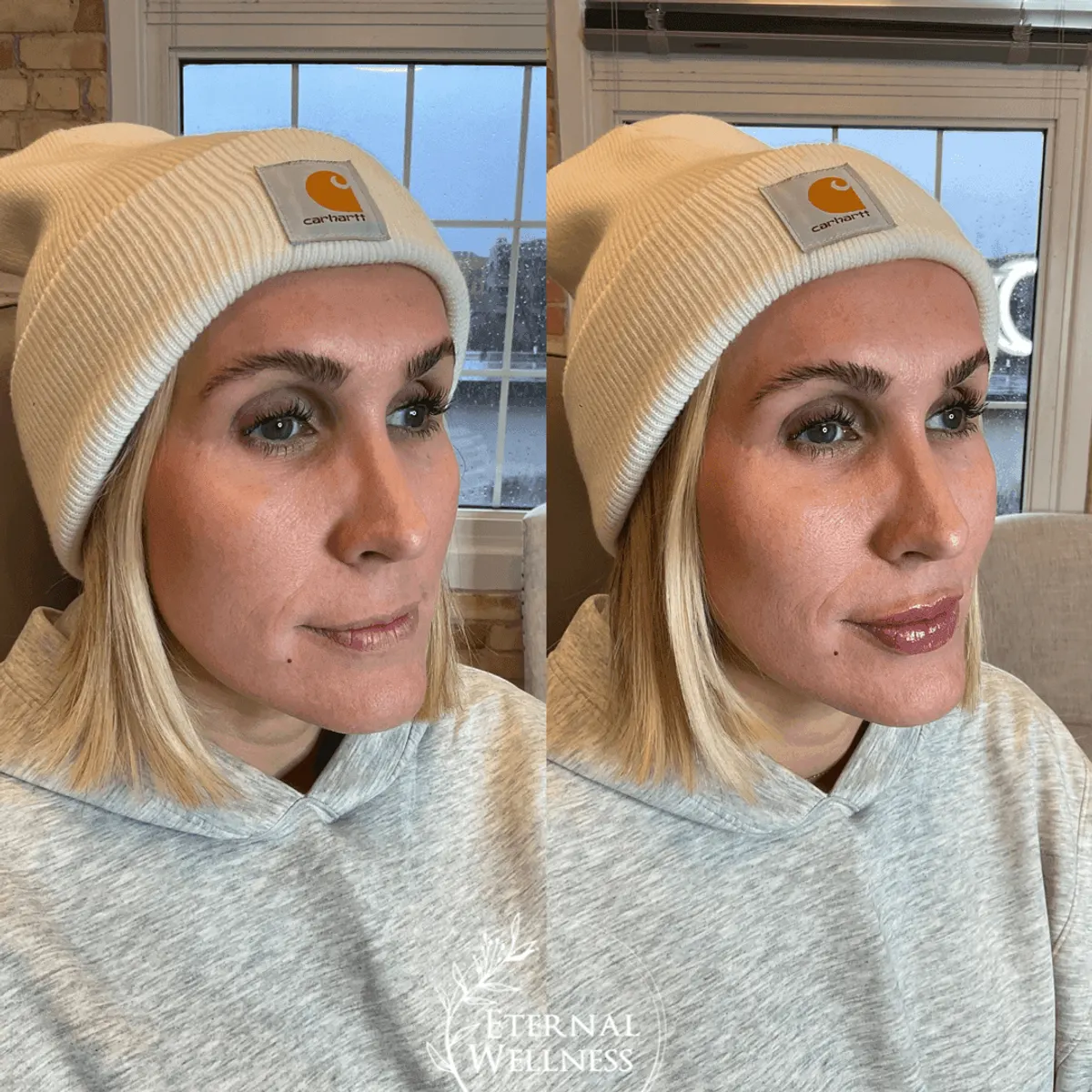 Restylane before and after