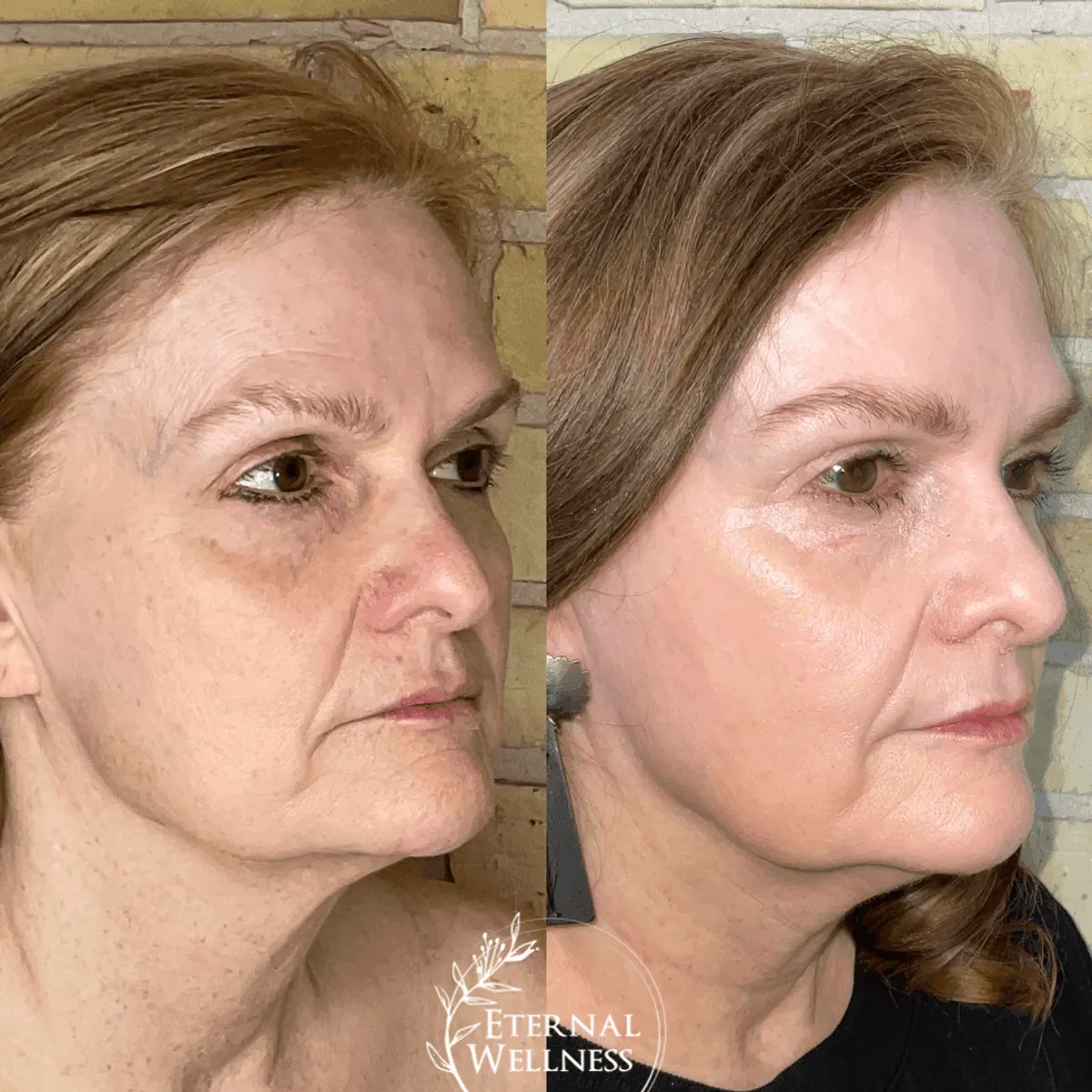 Morpheus8 Face before and after