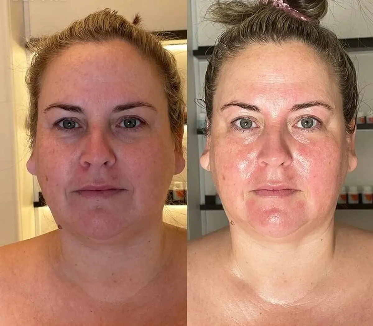 Lymphatic Drainage before and after