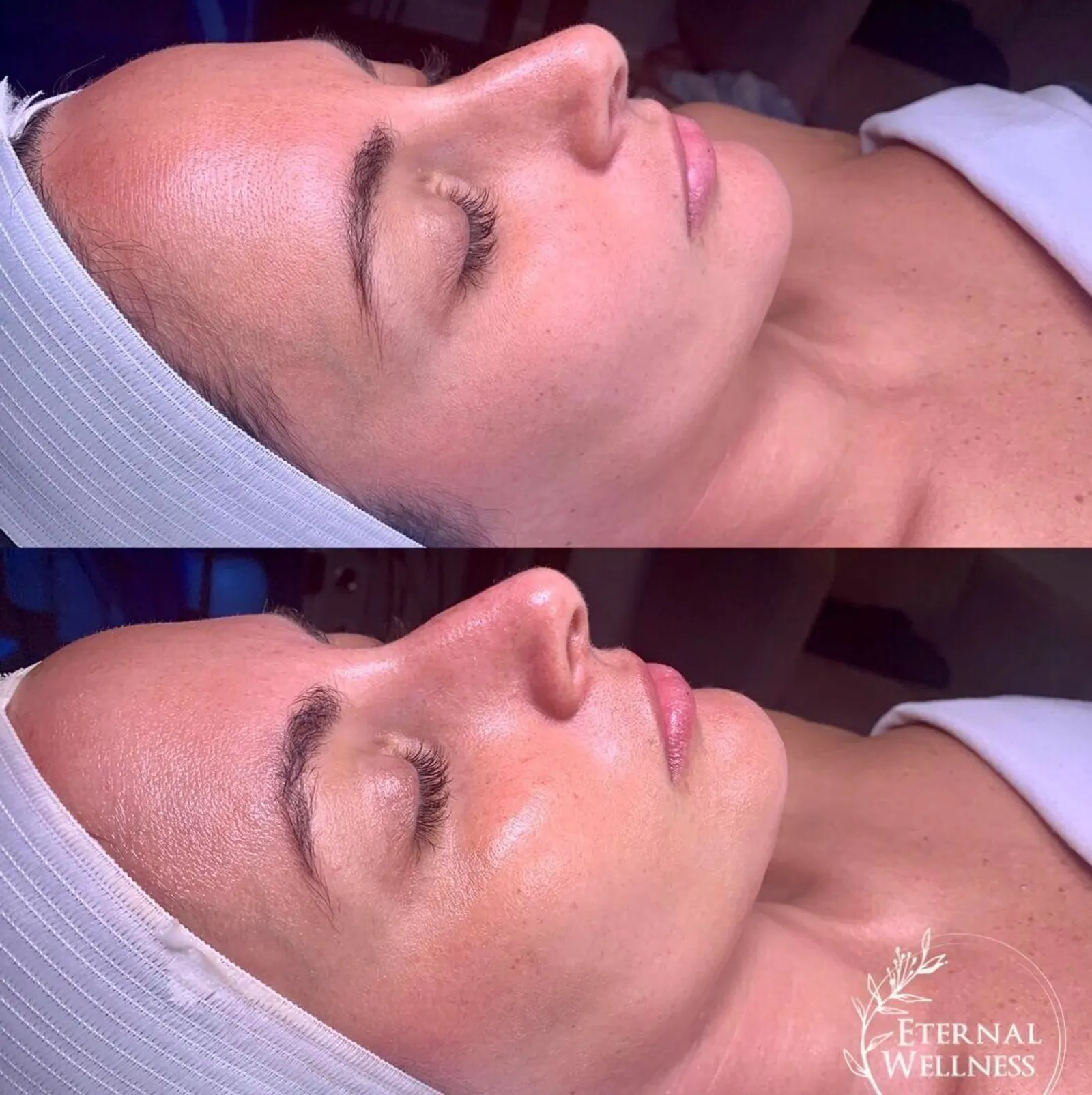 Hydrafacial - Before and After