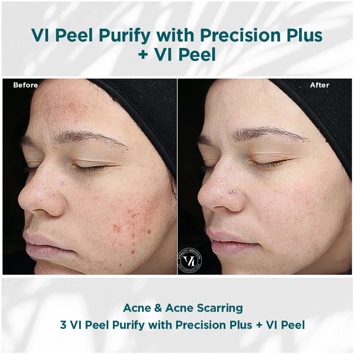 VI Chemical Peel before and after