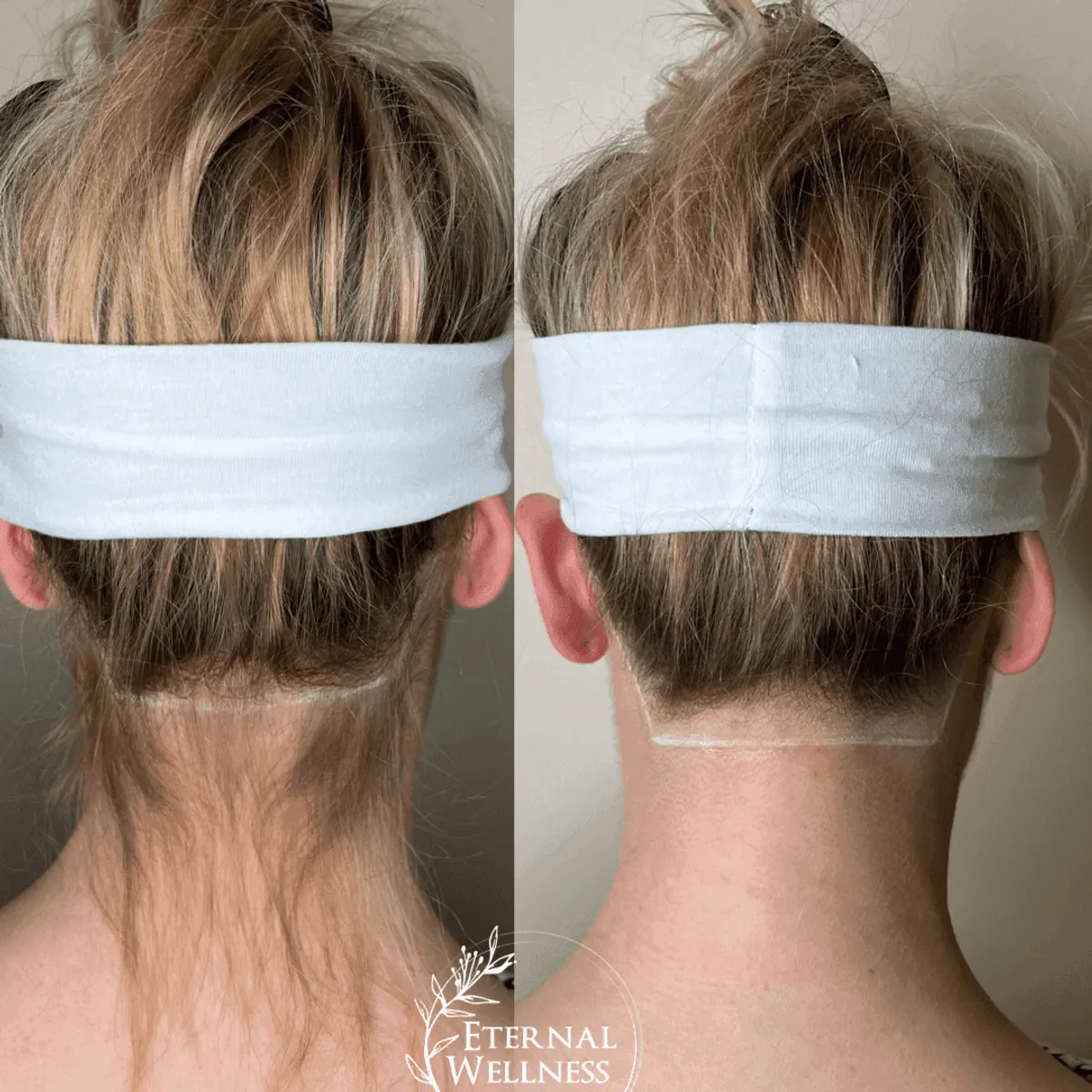 DiolazeXL Laser Hair Removal before and after