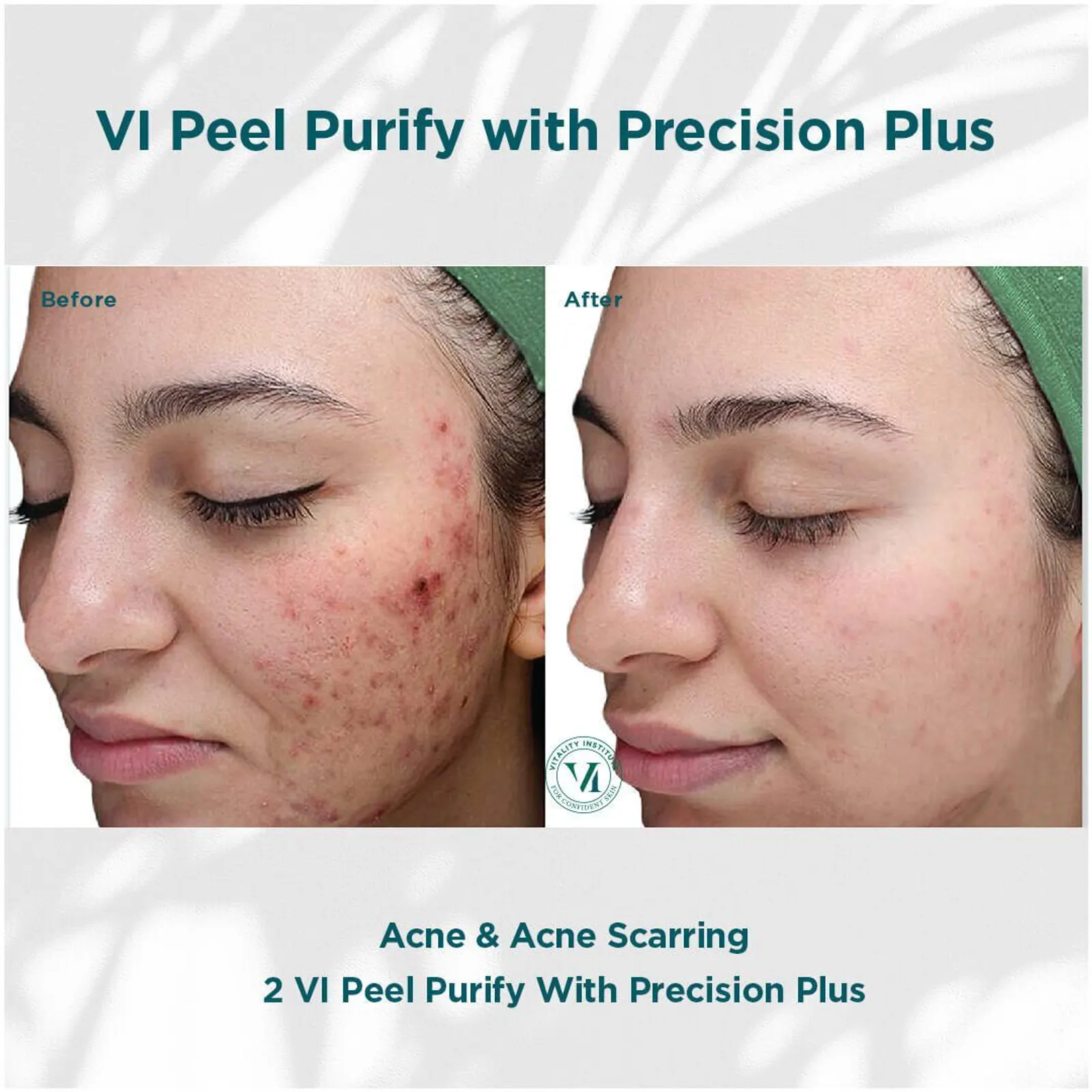 VI Chemical Peel - Before and After