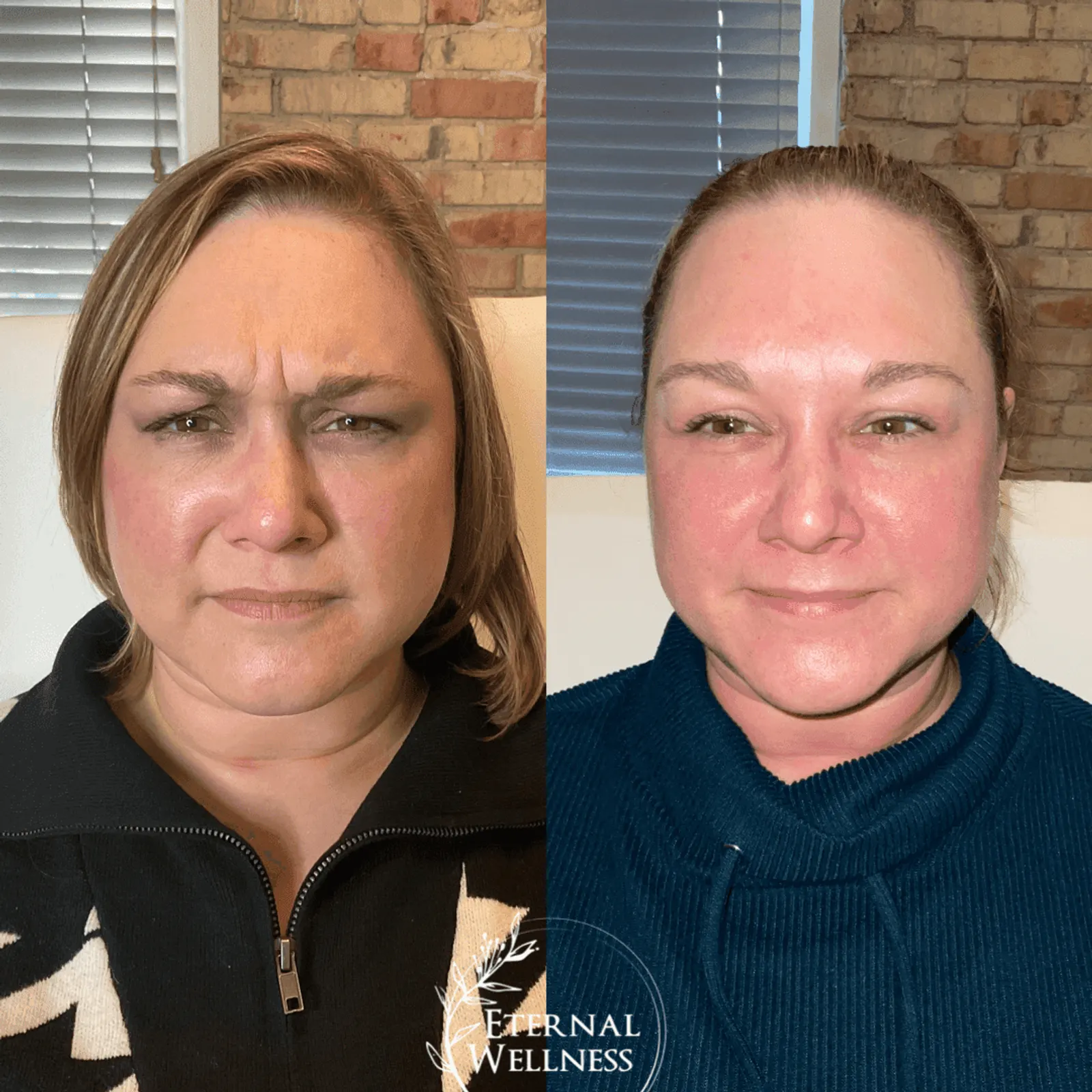 Dysport - Before and After