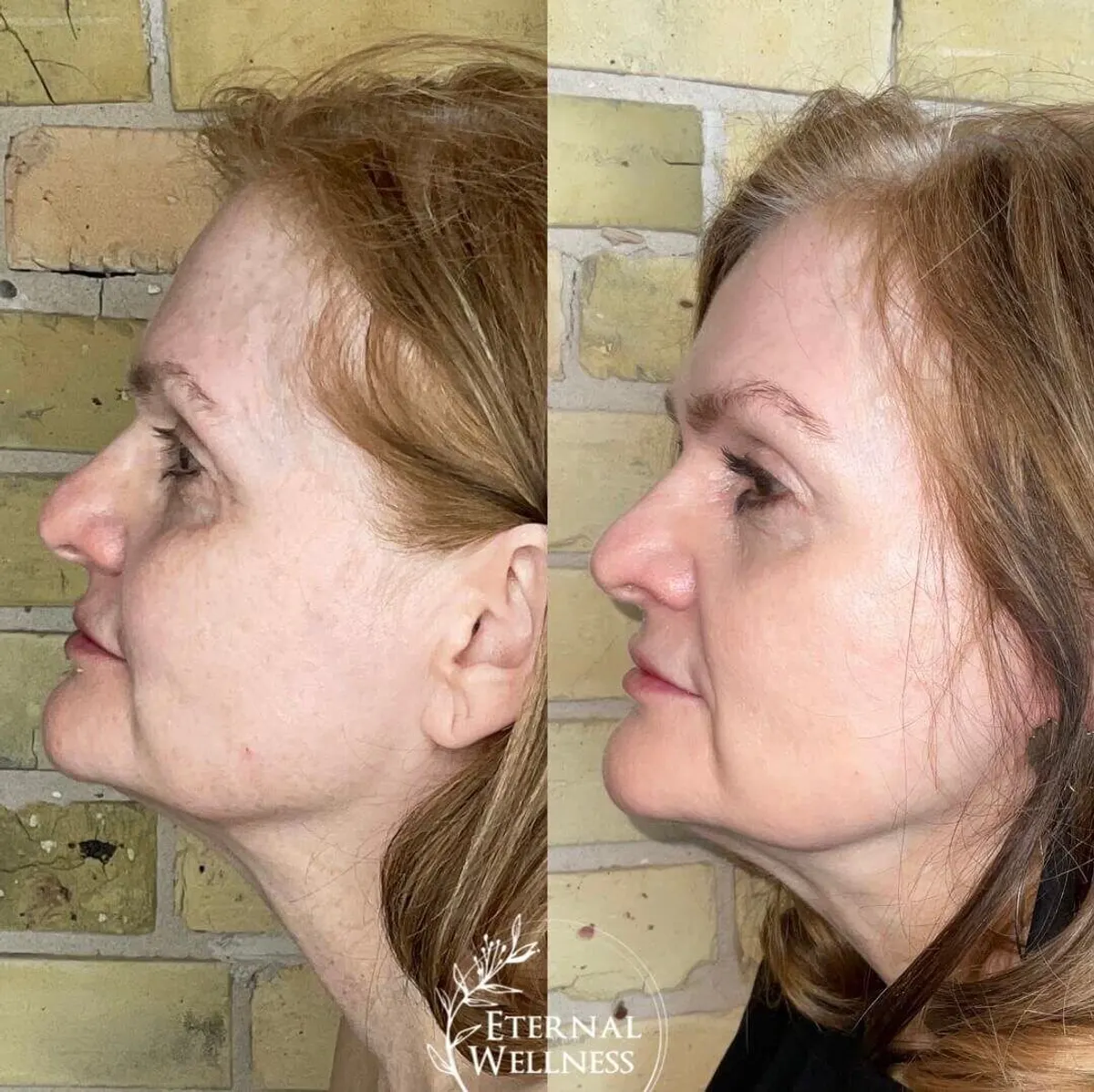 Morpheus8 Face before and after
