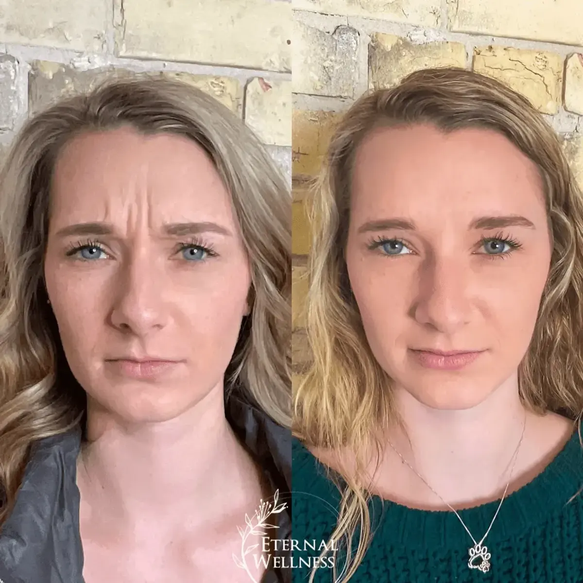 Botox before and after