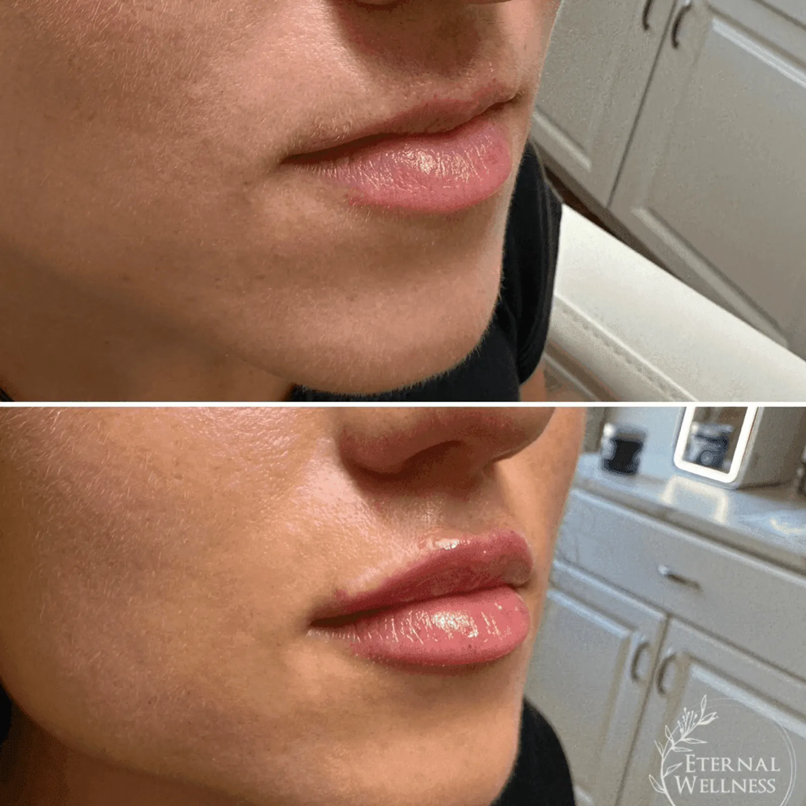 Lip Injections - Before and After