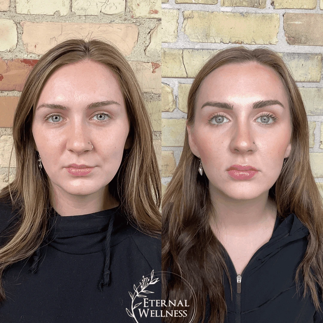 Dermal Fillers - Before and After