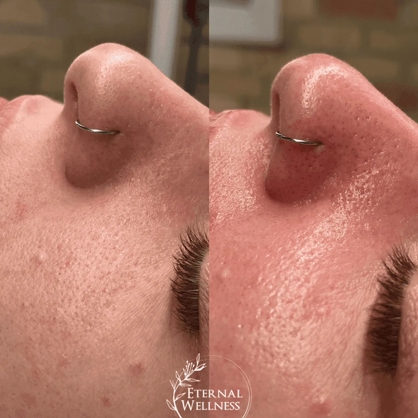 Hydrafacial - Before and After