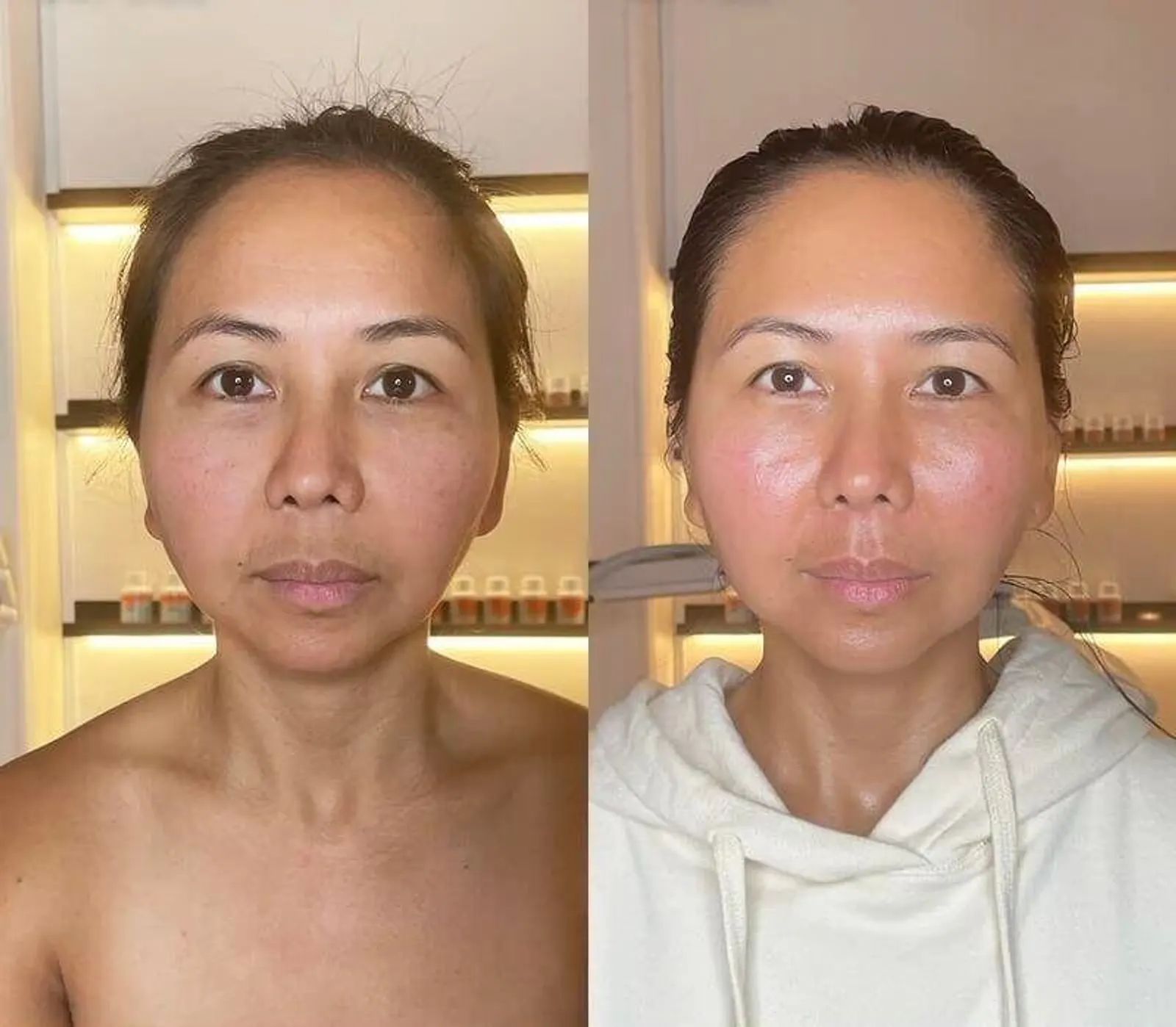 Lymphatic Drainage - Before and After
