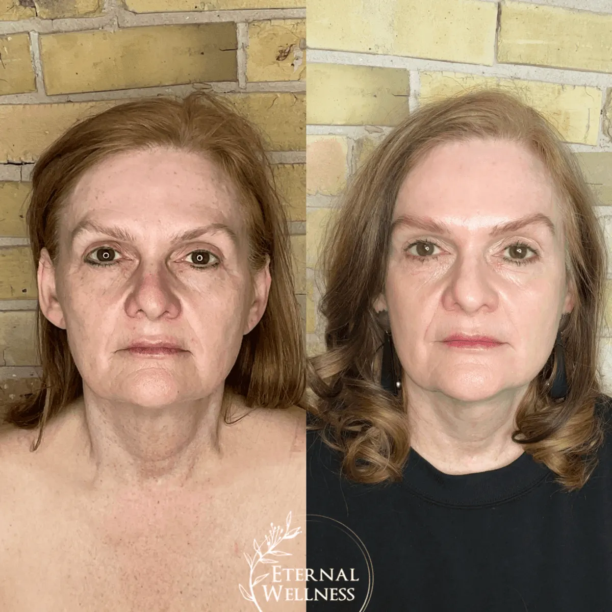 Morpheus8 Face before and after