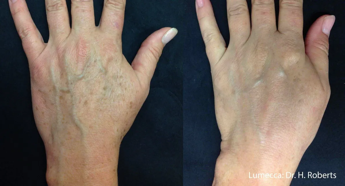 Lumecca IPL Body before and after
