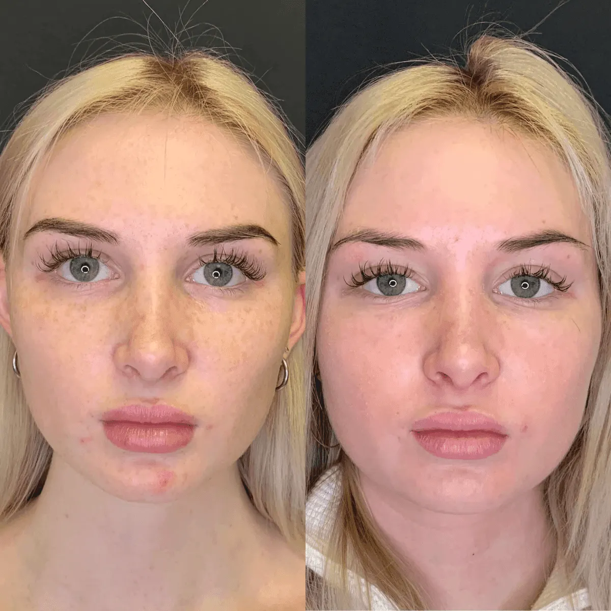 PRP & PRF before and after