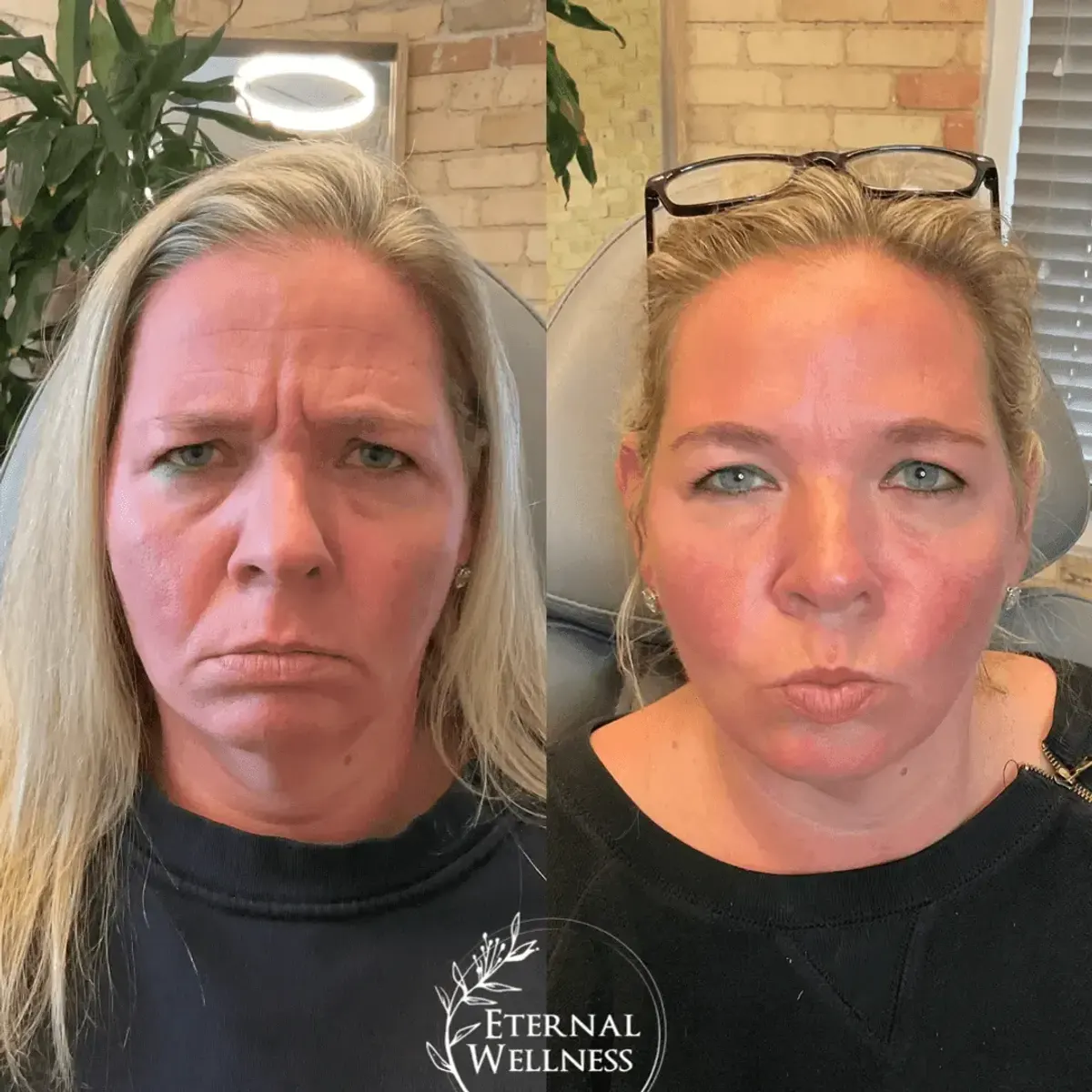 Dysport before and after
