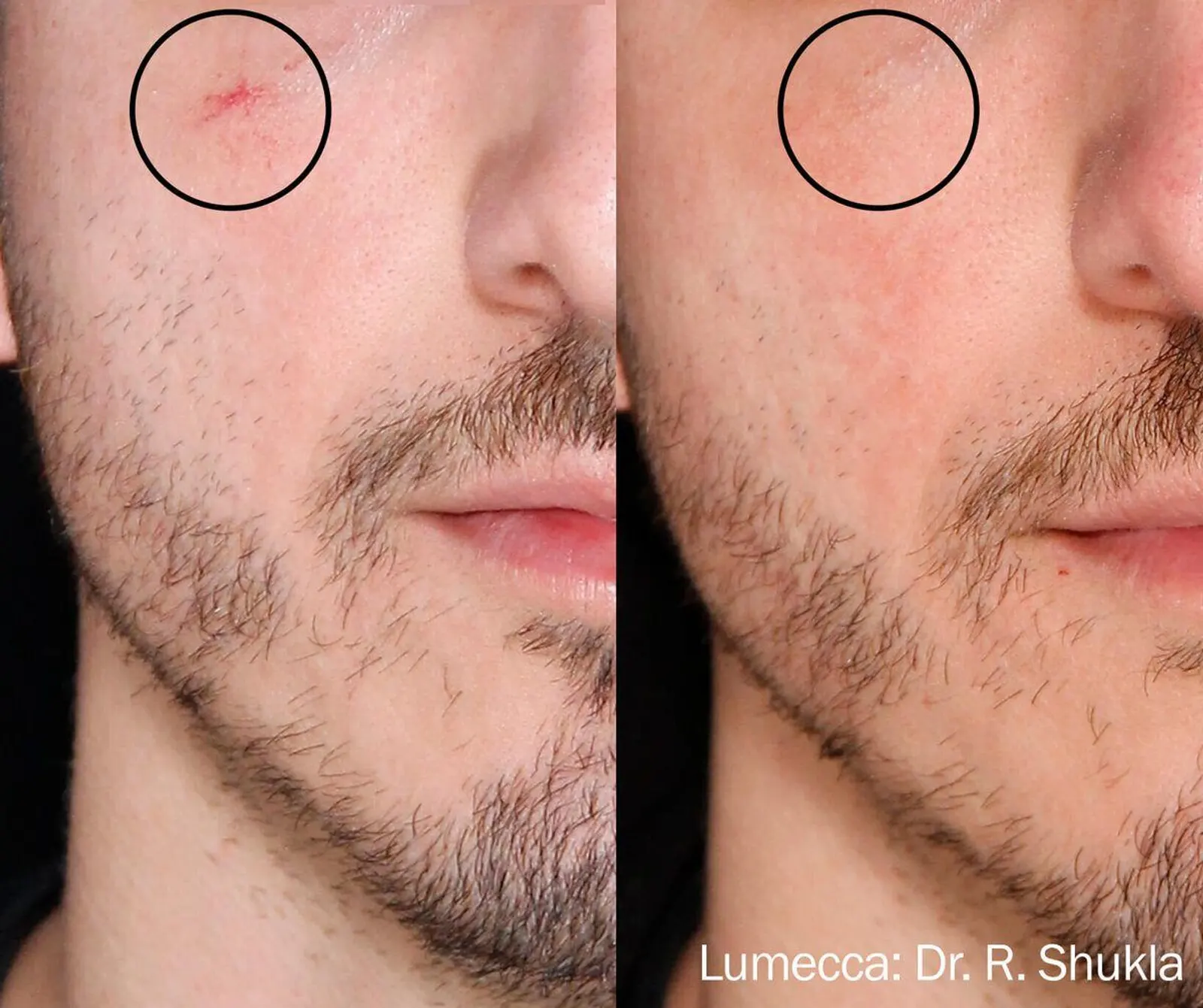 Lumecca IPL Face - Before and After