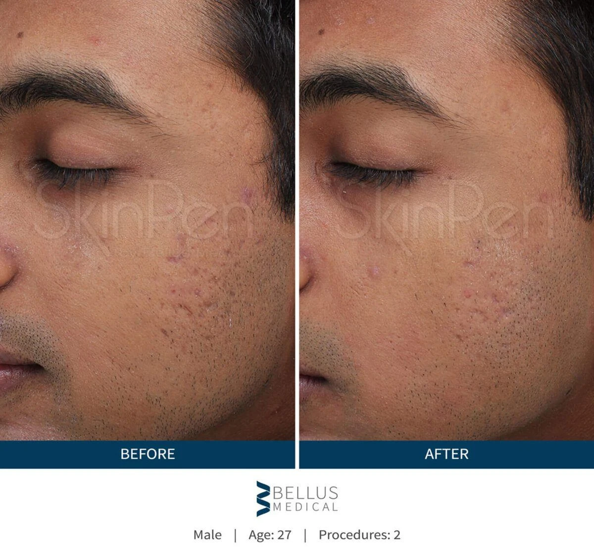 SkinPen - Before and After