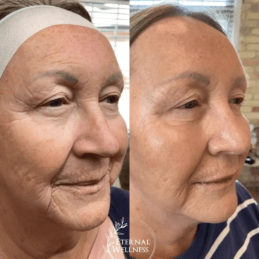Dermal Fillers - Before and After