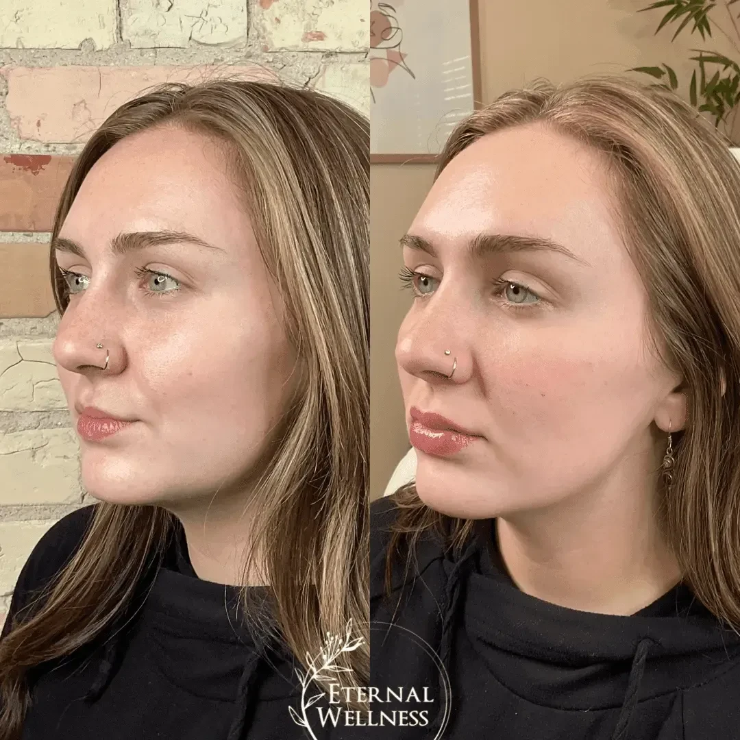 Dermal Fillers - Before and After
