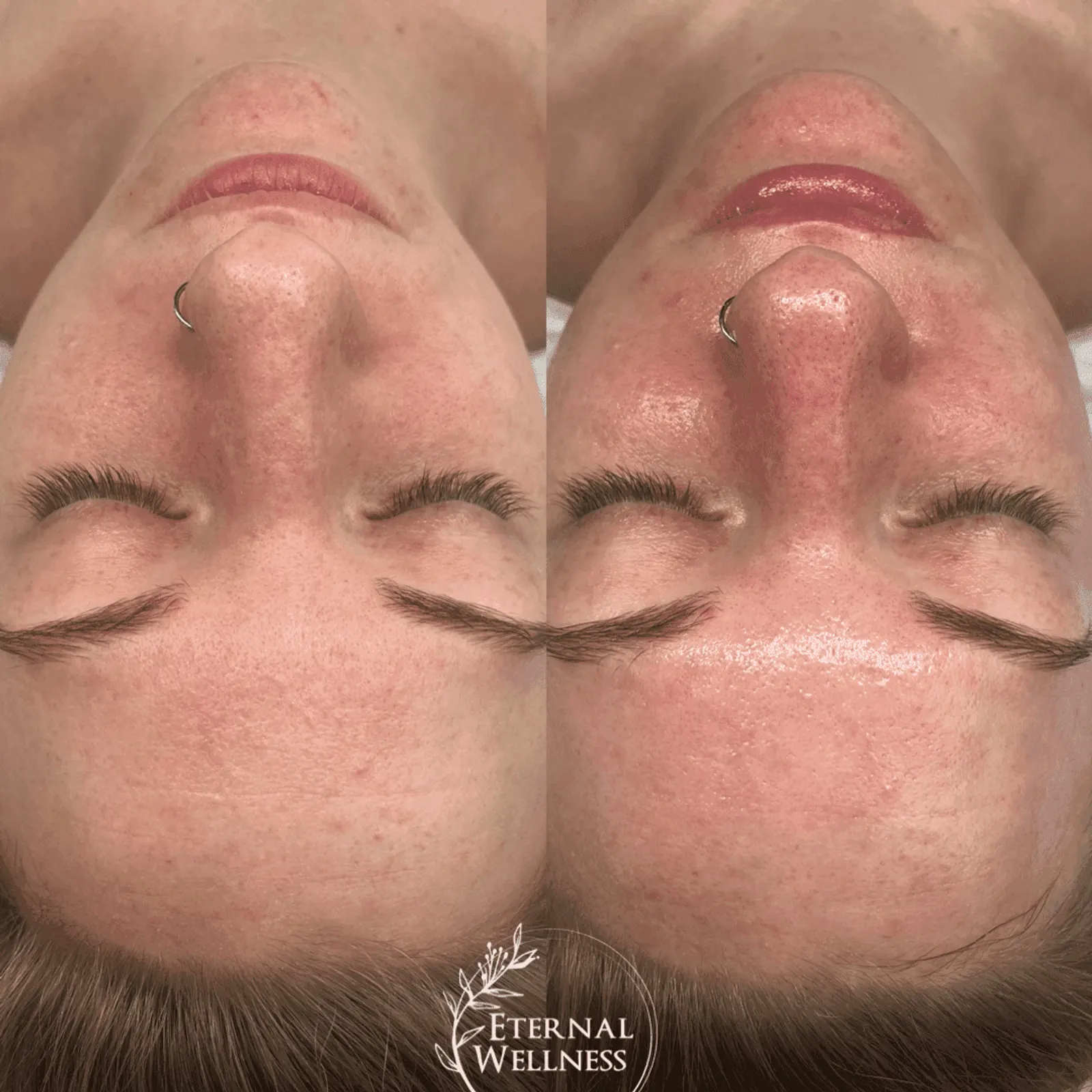 Hydrafacial - Before and After