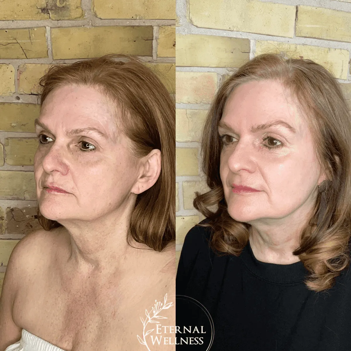 Morpheus8 Face before and after