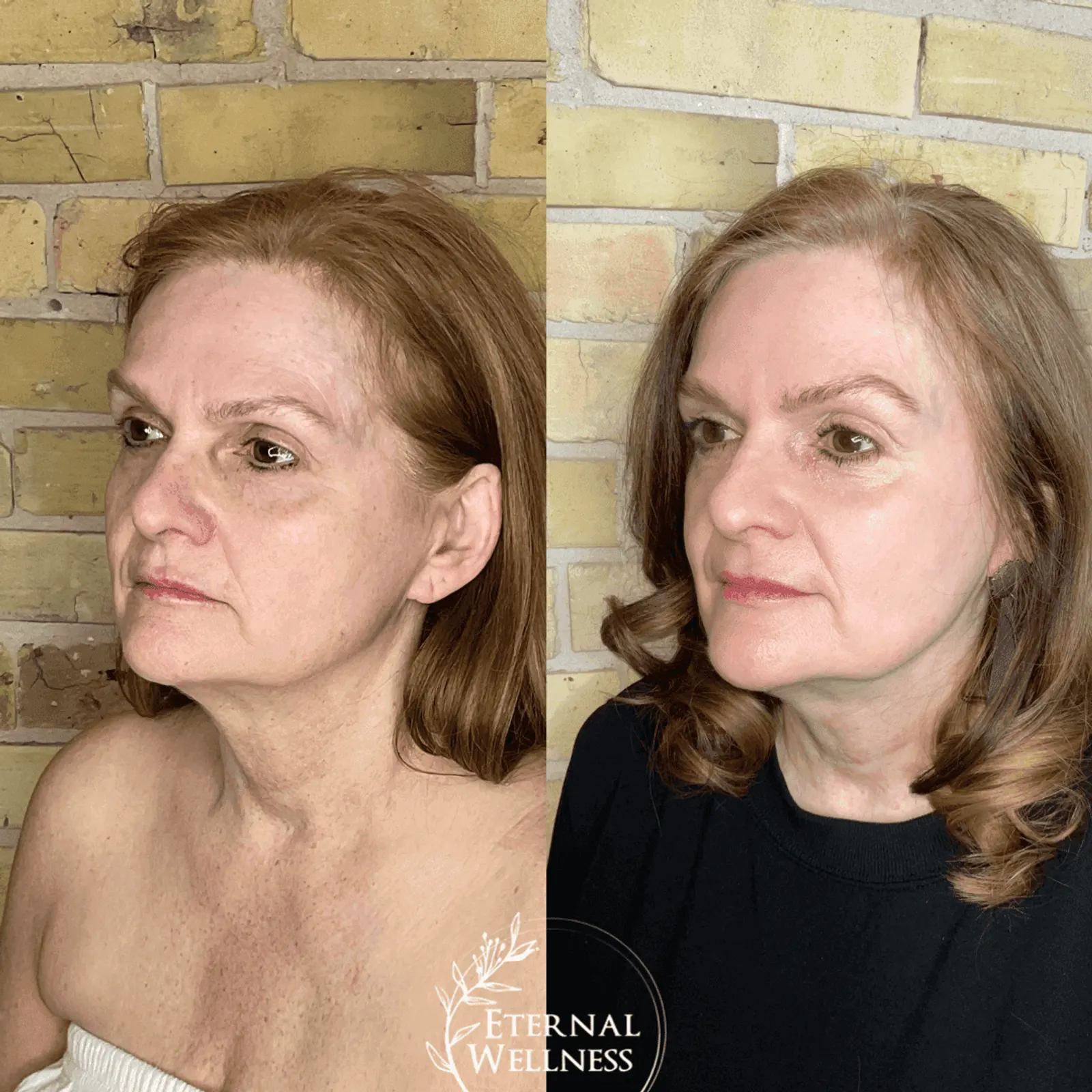 Morpheus8 Face - Before and After