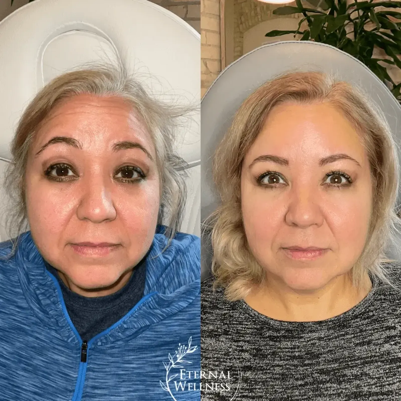 Botox - Before and After