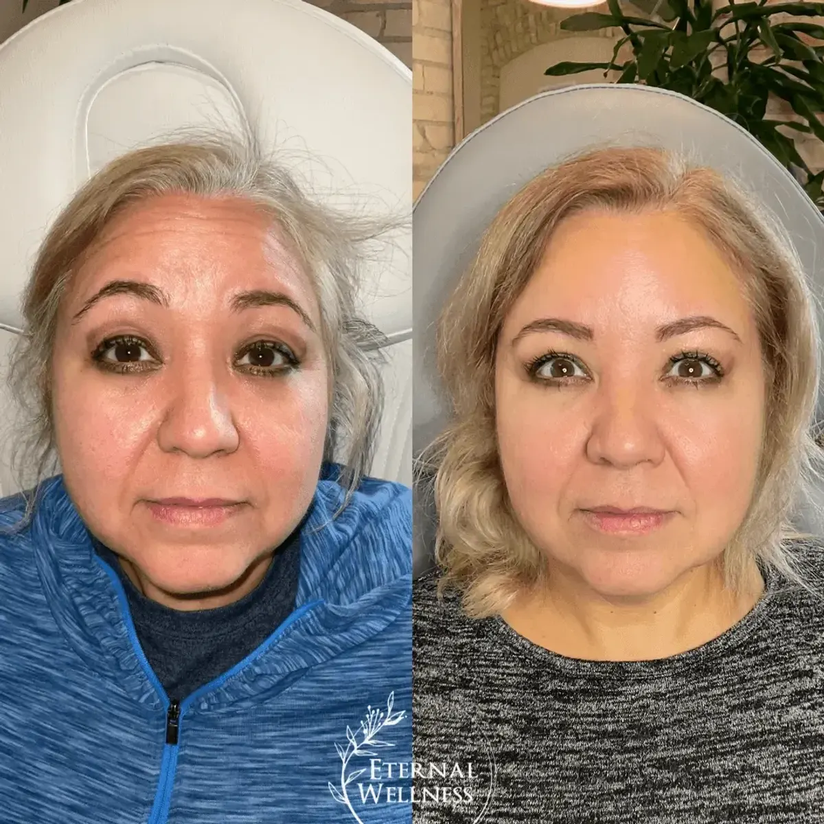 Botox before and after