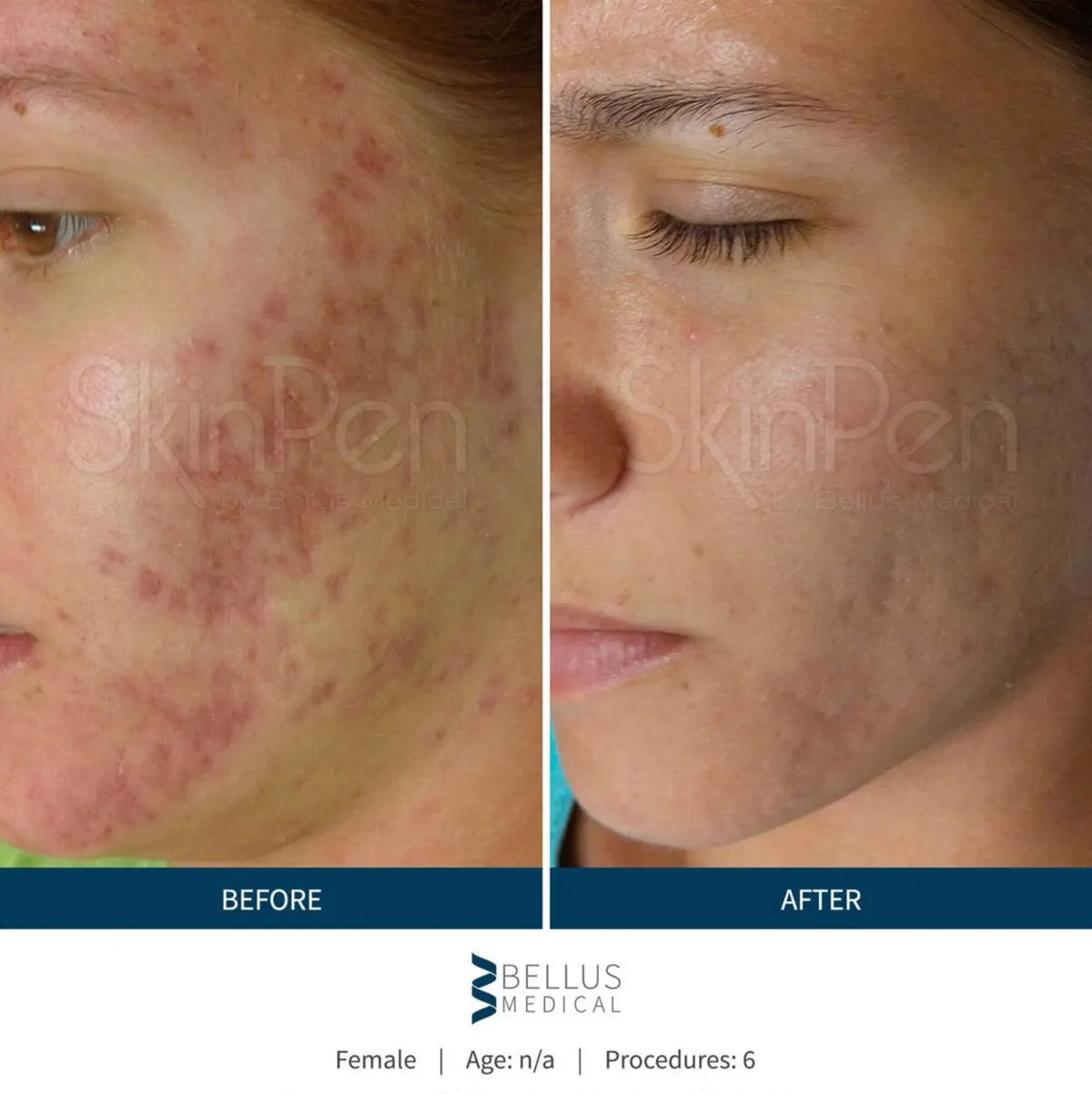 SkinPen before and after