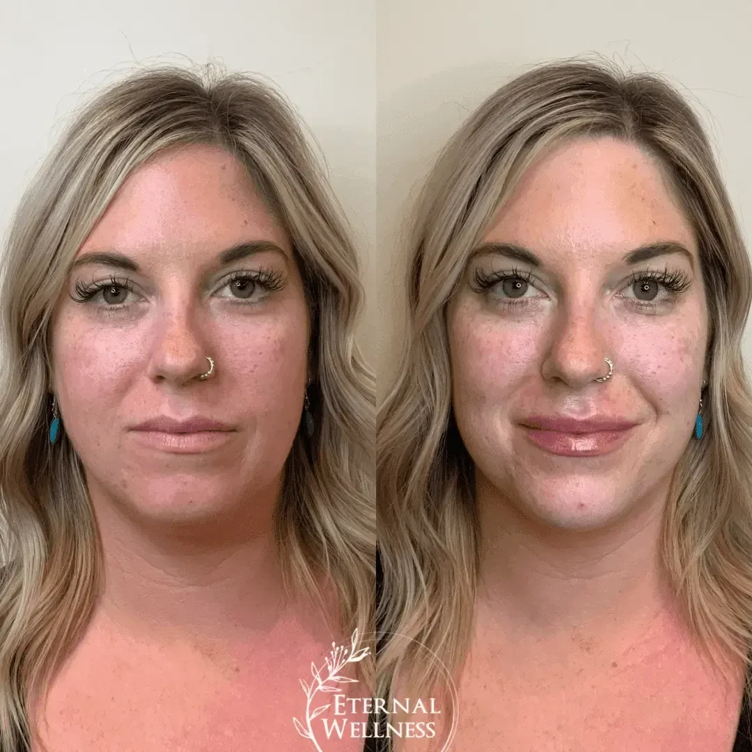 Dermal Fillers - Before and After