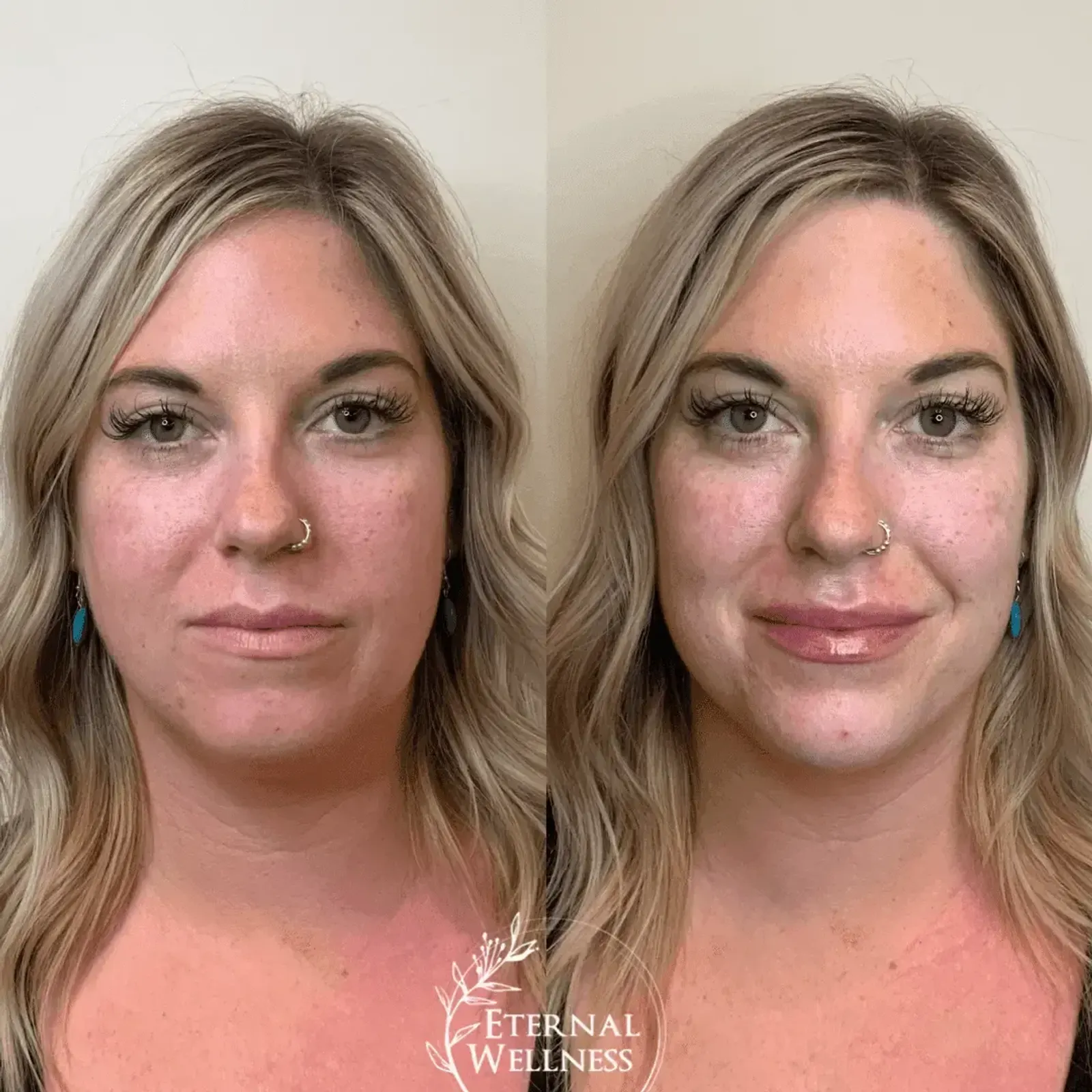 Dermal Fillers - Before and After
