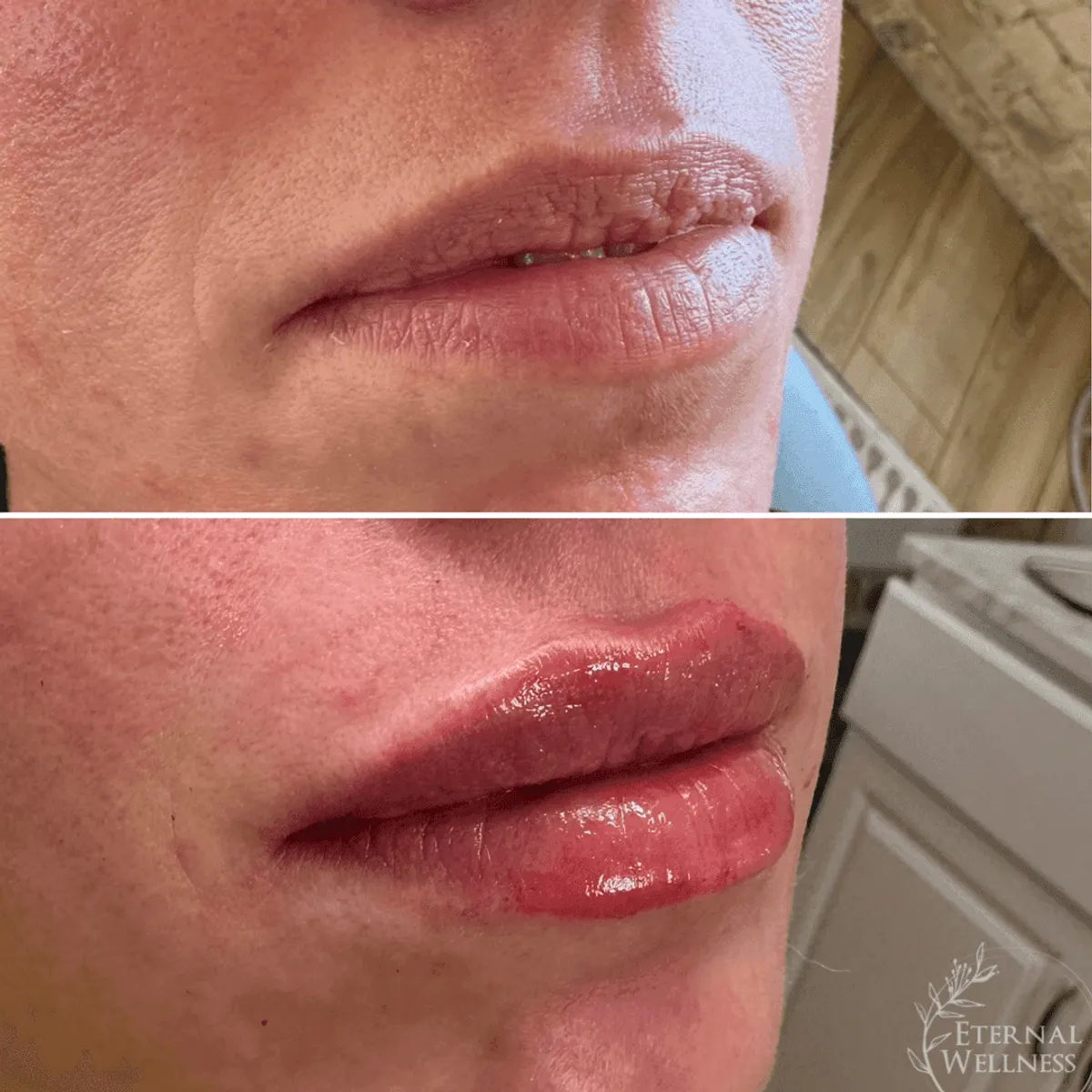 Restylane before and after